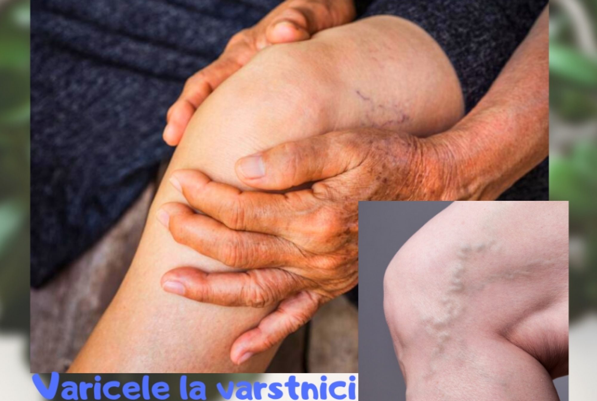 Cum se justifica frecventa varicelor la persoanele in etate?